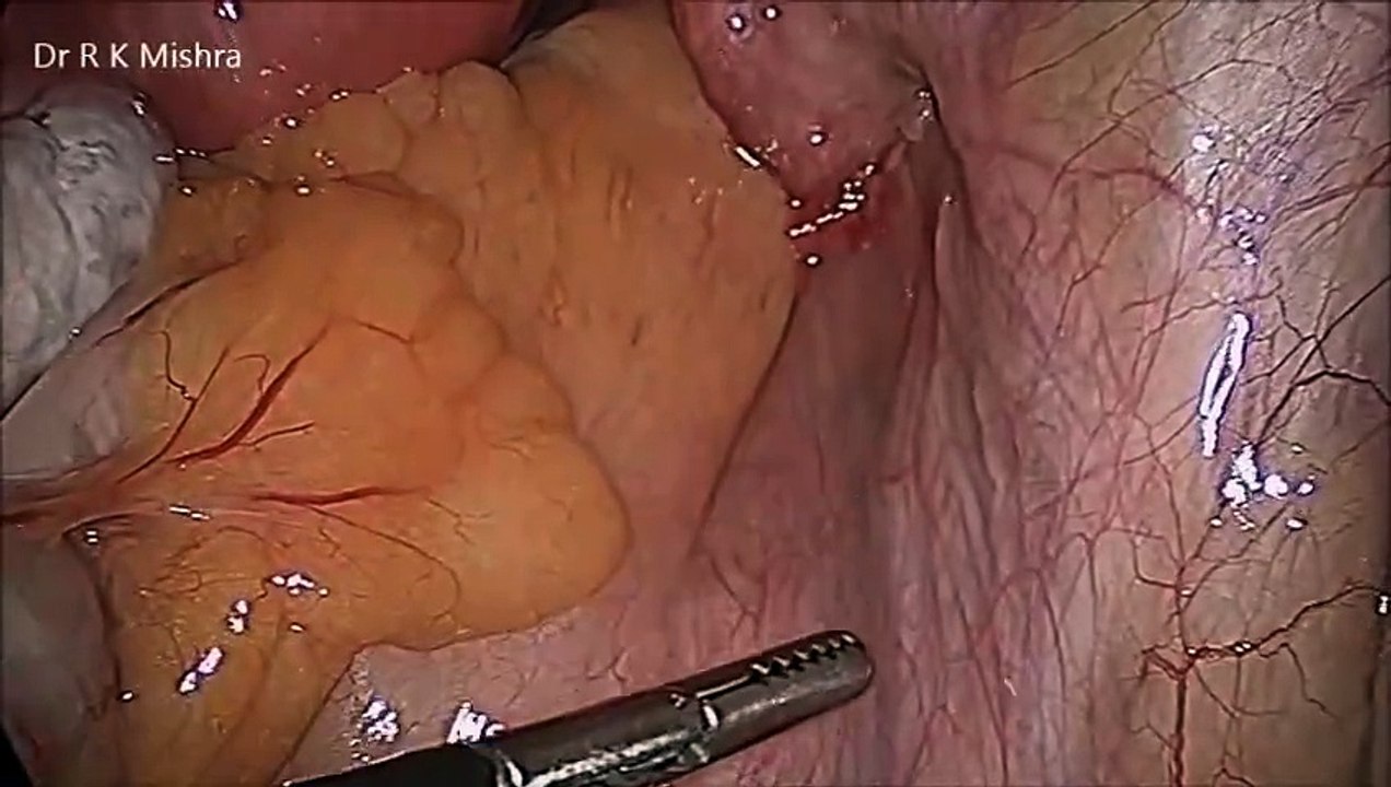 Diagnostic Laparoscopy and Demonstration of Laparoscopic Anatomy