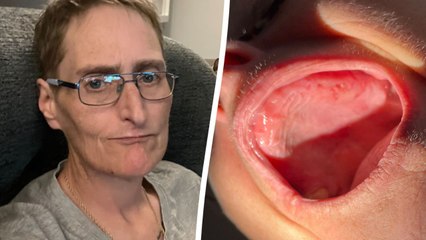 Nurse has malnutrition after dentist removes nearly all her teeth