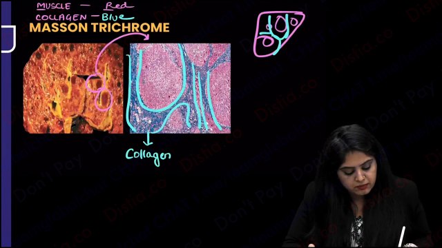 Liver Cirhosis, tumors // pathology