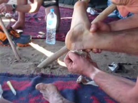 Ampoules Marathon des Sables 2008