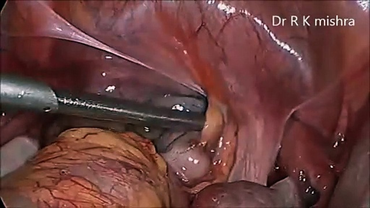Diagnostic Laparoscopy for Developmental Anomalies of the Müllerian Duct