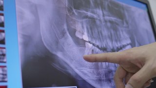 Mann will sich Zahn-Implantat setzen lassen: Plötzlich ist es in seinem Gehirn