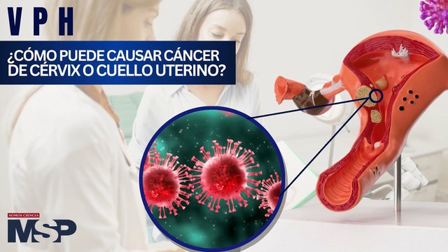 VPH: ¿Cómo puede causar cáncer de cérvix o cuello uterino? - #ExclusivoMSP