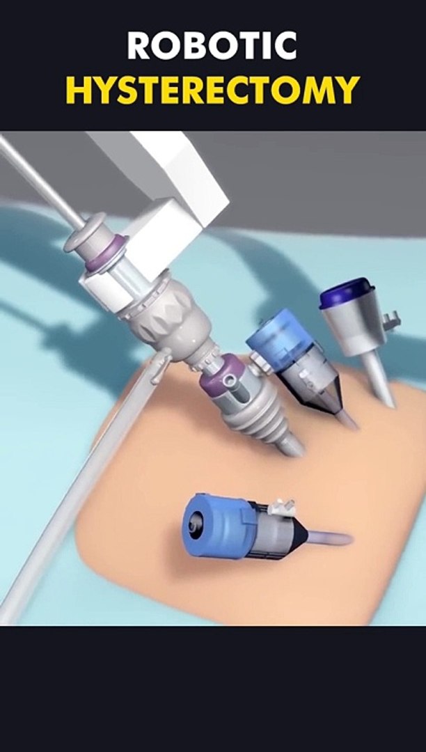 ⁣Robotic Hysterectomy Procedure 3D Animation