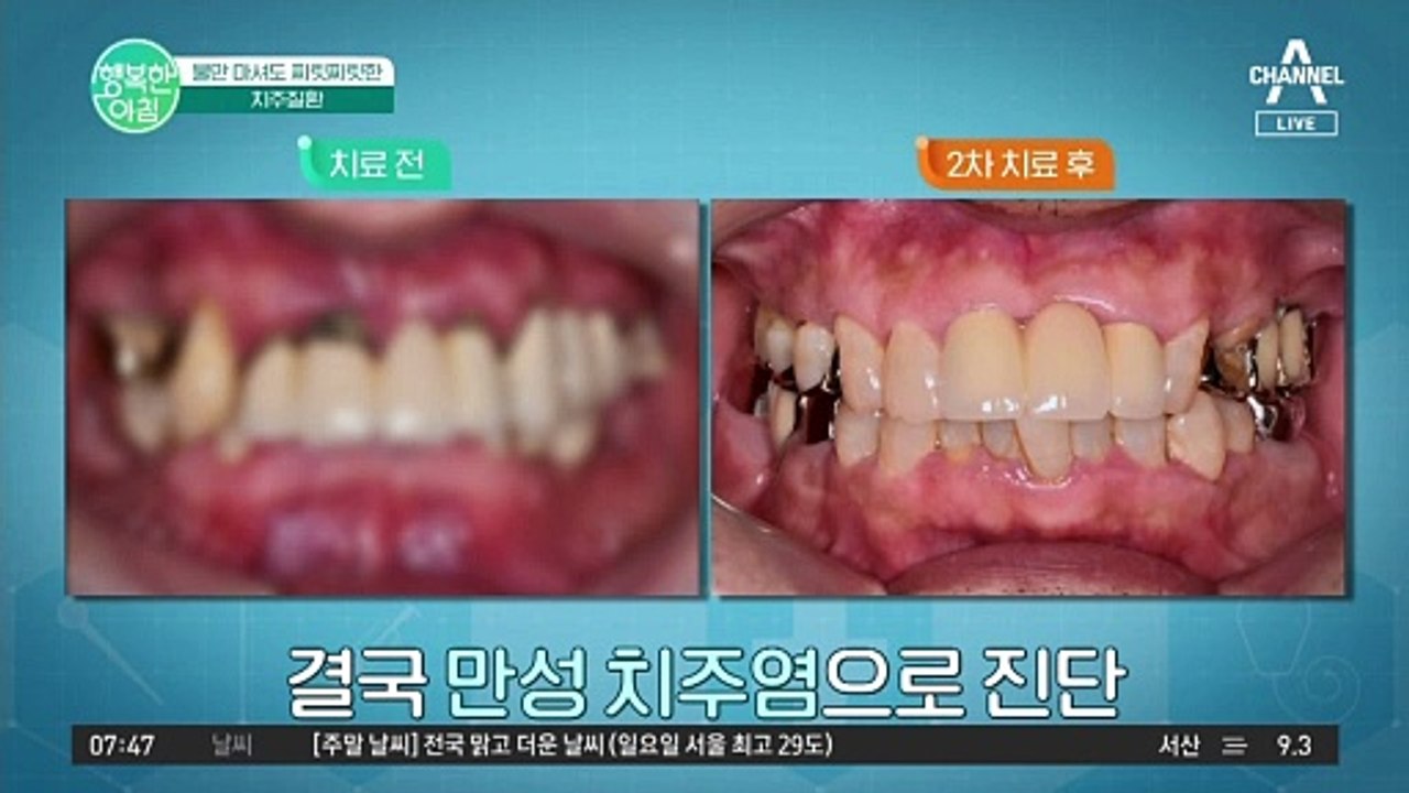 [닥터하우스] 물만 마셔도 찌릿찌릿한 치아? 치아 수명을 지키는 방법 #치과치료