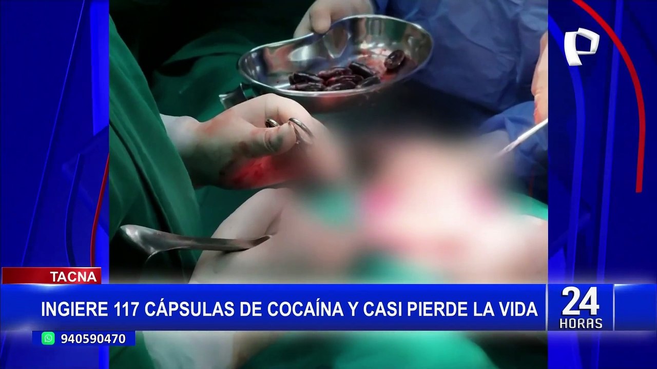 Tacna: salvan a hombre de morir por llevar 117 cápsulas de cocaína en el estomago