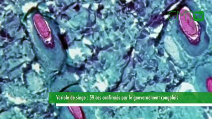 [#Reportage] Variole de singe : 59 cas confirmés par le gouvernement congolais
