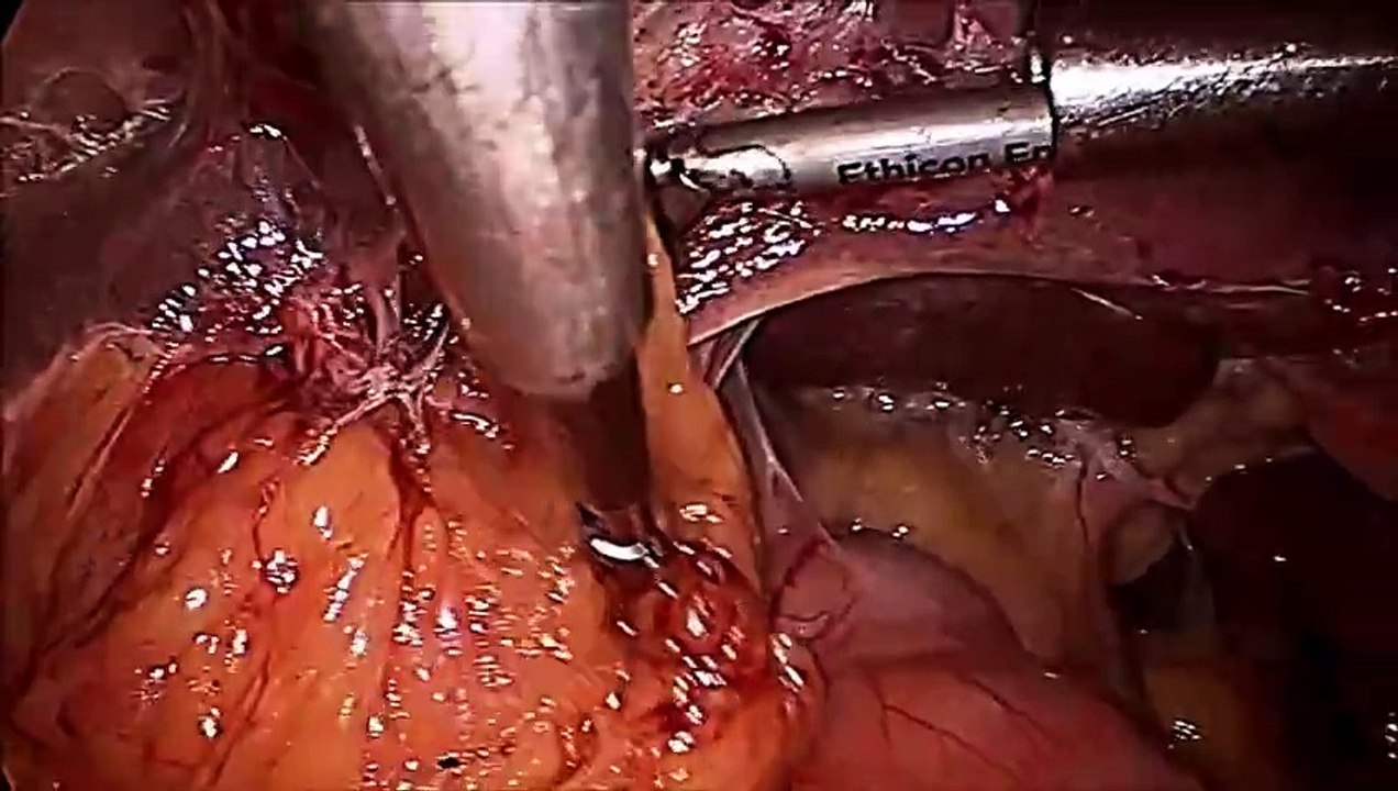 Difficult Laparoscopic Cholecystectomy for Large Gallbladder Stone for Chronic Cholecystitis