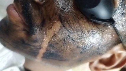 ত্বক ফর্সা ও গ্লোয়িং করতে কার্বন ফেসিয়াল করুন | ময়মনসিংহ লেজার চিকিৎসা