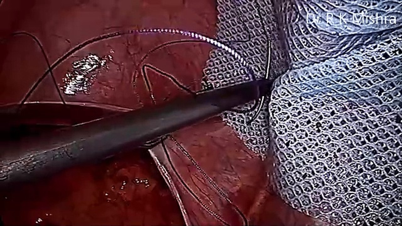 IPOM Inguinal Hernia Repair by Laparoscopy