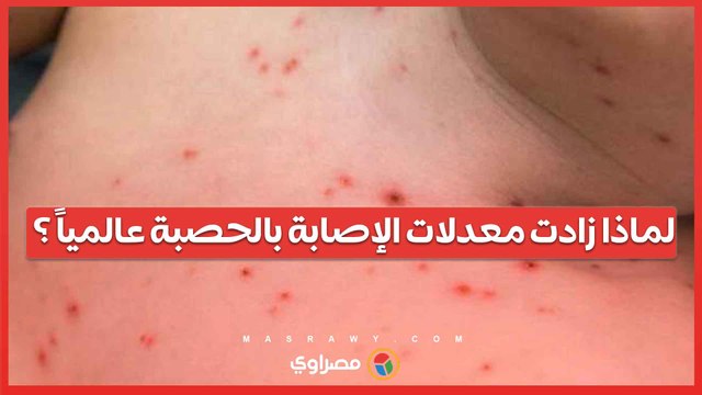 لماذا زادت معدلات الإصابة بالحصبة عالمياً ؟