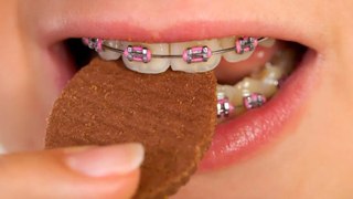 Ortodontista alerta pacientes para alimentos contraindicados para quem usa aparelho ortodôntico