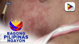 DOH, patuloy ang paalala sa mga magulang na pabakunahan ang anak vs. tigdas at pertussis
