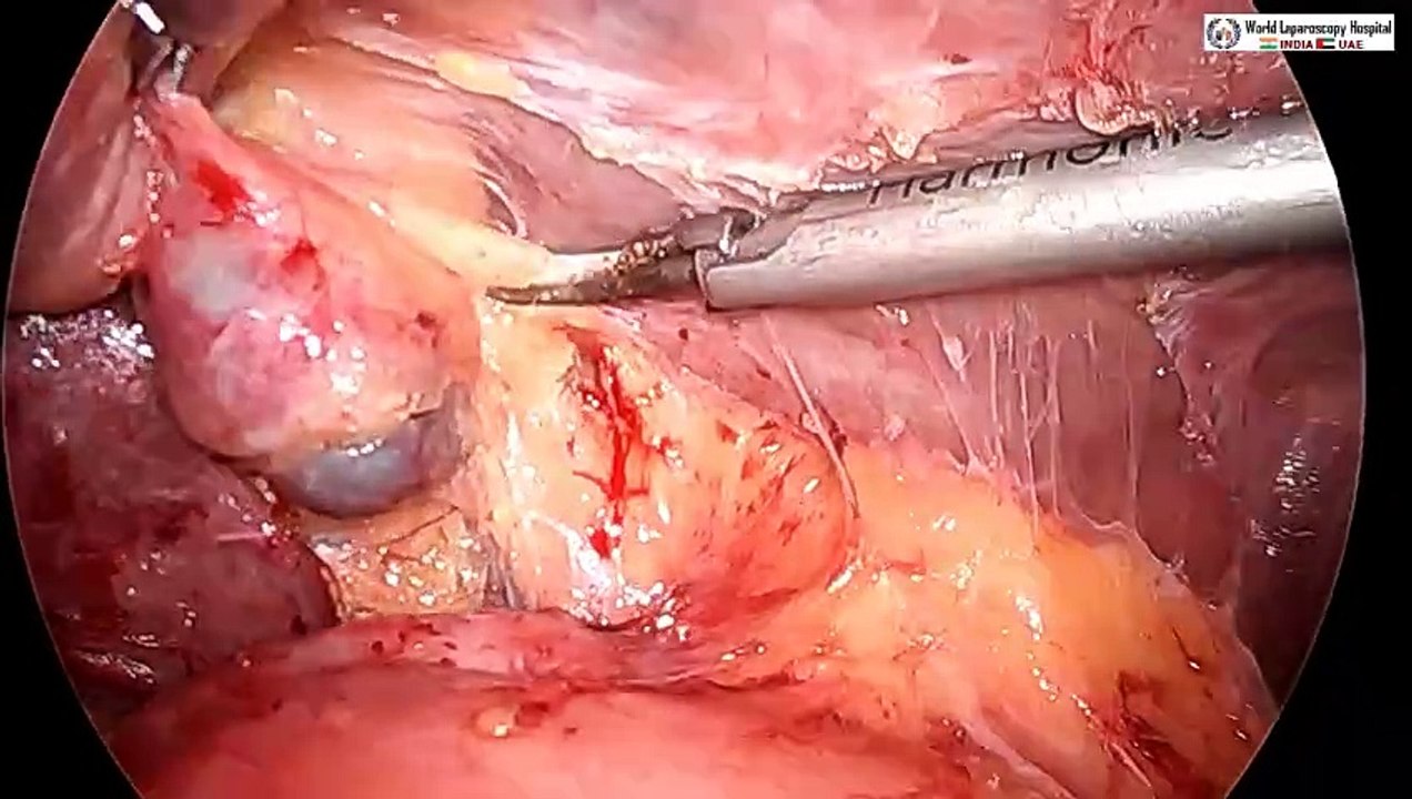 Difficult Laparoscopic Cholecystectomy performed by Pledget Dissection of Calot's triangle