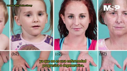 Artrogriposis múltiple congénita: ¿Qué es y cómo funciona? - #EspecialMSP