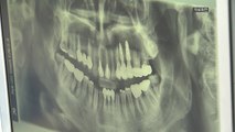 [대구] 대구시, 버려지던 치아로 임플란트용 골이식재 개발 추진 / YTN