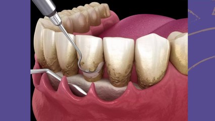 bd-dientes-flojos-y-posibles-soluciones-010524