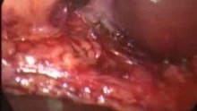 Laparoscopic cholecstectomy (SOS cystic artery)