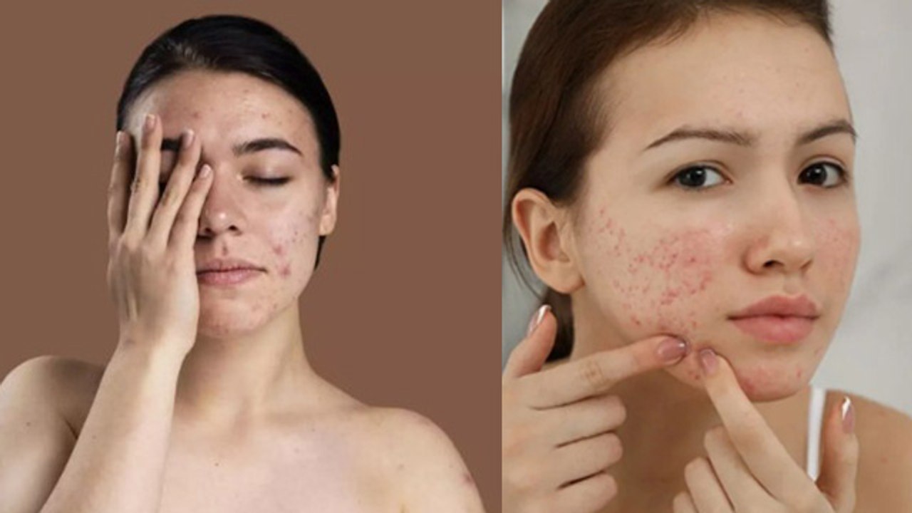 पिंपल फोड़ने से क्या होता है | Pimple Fodne Se Kya Hota hai | Boldsky