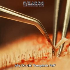 Why Do Hair Transplants Fail?