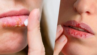 गर्मियों में होंठ क्यों फटते है | Garmi Me Fate Hoto Ka Ilaj | Dry Lips In Summer Reason | Boldsky