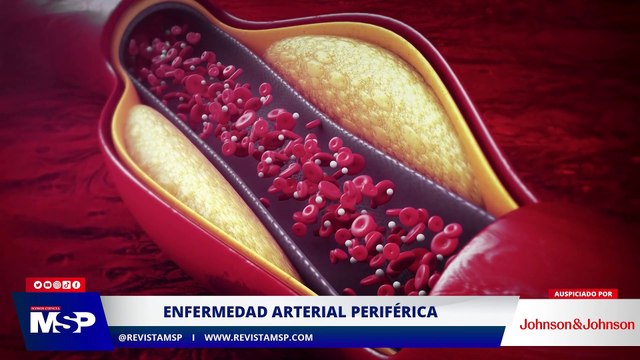Hablemos claro sobre la Enfermedad Arterial Periférica con un cardiólogo - #ExclusivoMSP