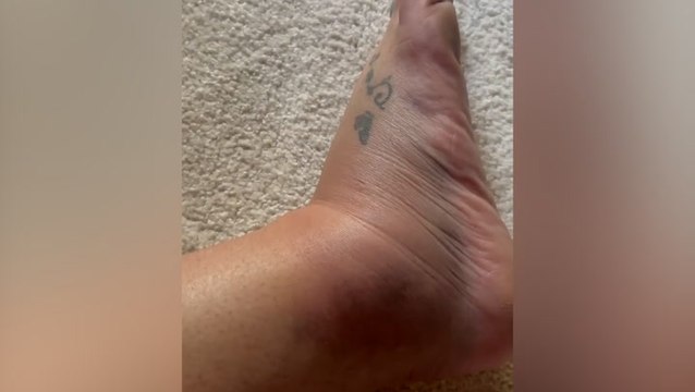 Britney Spears shares video of ‘painful’ injury after paramedics called to Los Angeles home