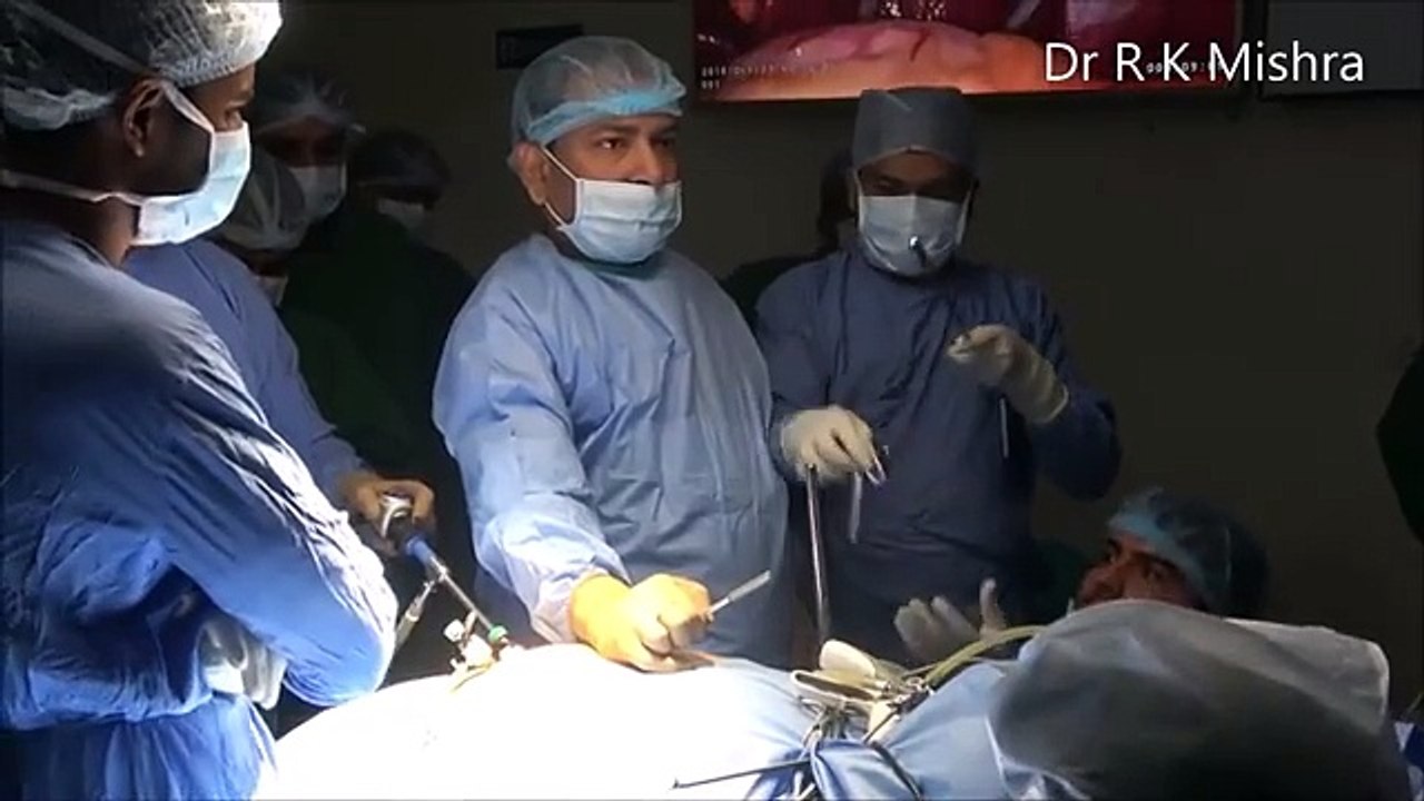 Bariatric Surgery Laparoscopic sleeve Gastrectomy Step by Step Video by Dr R K Mishra