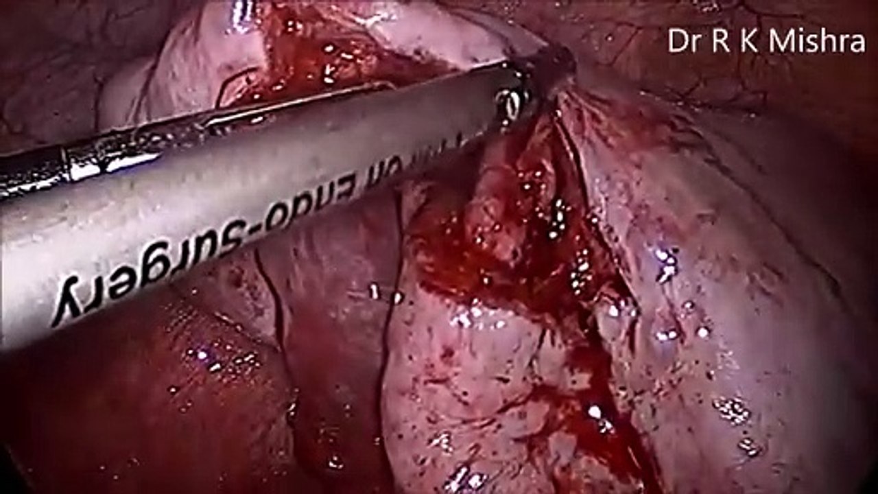 Torted Ovarian Dermoid Cyst in Pregnant Patient