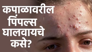 कपाळावरील पिंपल्स घालवायचे कसे? | How To Get Rid Of Forehead Pimples | Skin Care Tips
