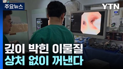 "부드럽게 쏙∼" 깊이 박힌 이물질, 상처 없이 꺼내는 내시경 로봇 / YTN