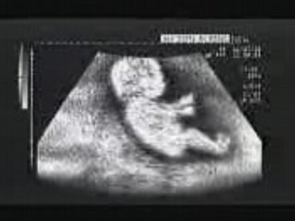 Echographie