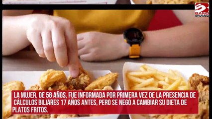 Extirpan 468 cálculos biliares a una mujer debido a su dieta grasa