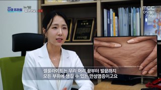 [HOT] The Effects of Female Hormones on Cellulite, MBC 다큐프라임 240505