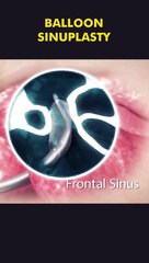 Balloon Sinuplasty Procedure 3D Animation