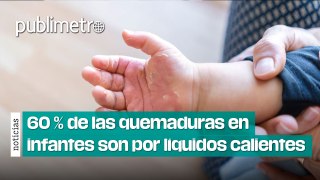 México 60 % de las quemaduras en infantes son causadas por líquidos calientes