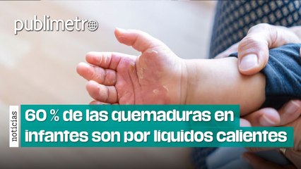 México 60 % de las quemaduras en infantes son causadas por líquidos calientes