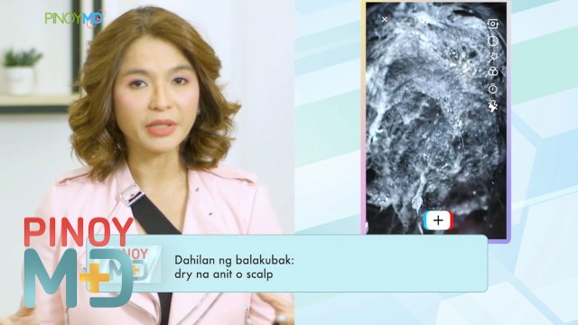 Pagkakaroon ng balakubak, paano masosolusyunan? | Pinoy MD