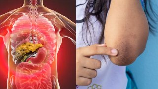 Liver Damage का Skin Symptoms, Acanthosis Nigricans Kya Hota Hai | Boldsky