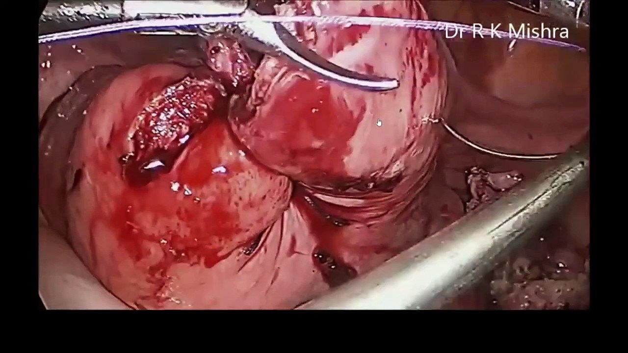 Dr Mishra's Lecture on Laparoscopic Myomectomy