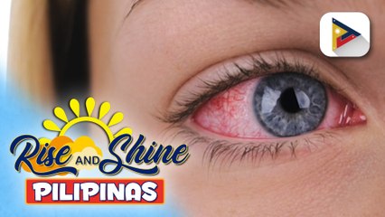 SAY ni DOK | Mga dapat at hindi dapat gawin kapag tinamaan ng sore eyes