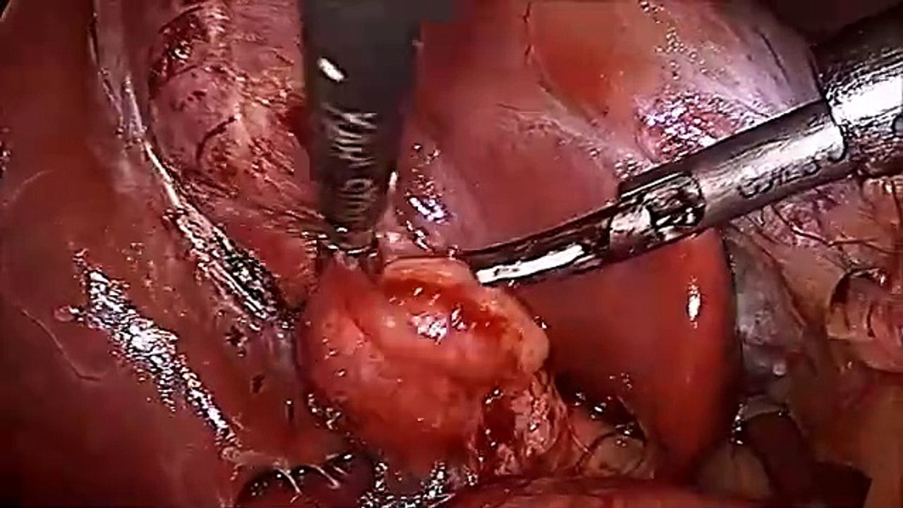 Mucocele of Gallbladder with Impacted Stone at Neck Operated by Mishras Knot