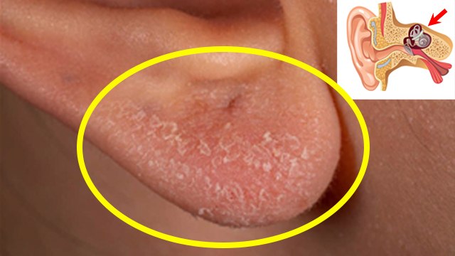 Ear Eczema Treatment: Causes, Symptoms In Hindi | कान में एक्जिमा लक्षण, कारण और उपचार | Boldsky