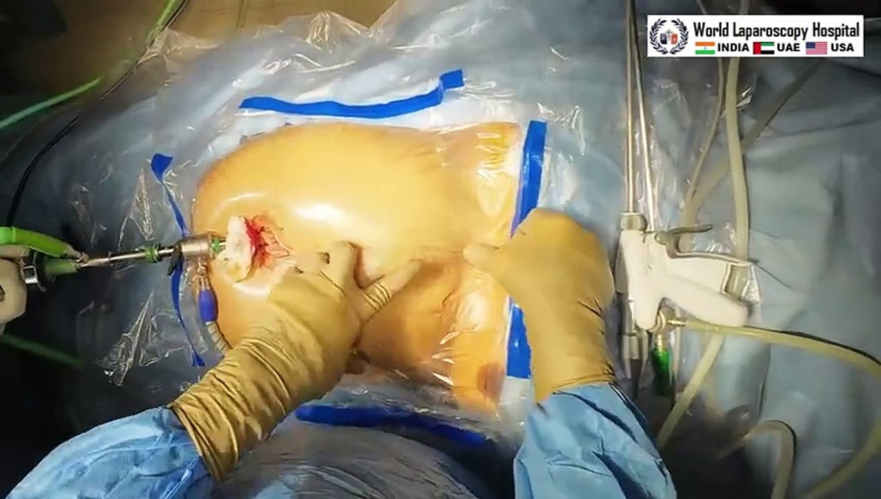 Laparoscopic Cholecystectomy and  Appendectomy through the same port using Mishras Knot and ICG