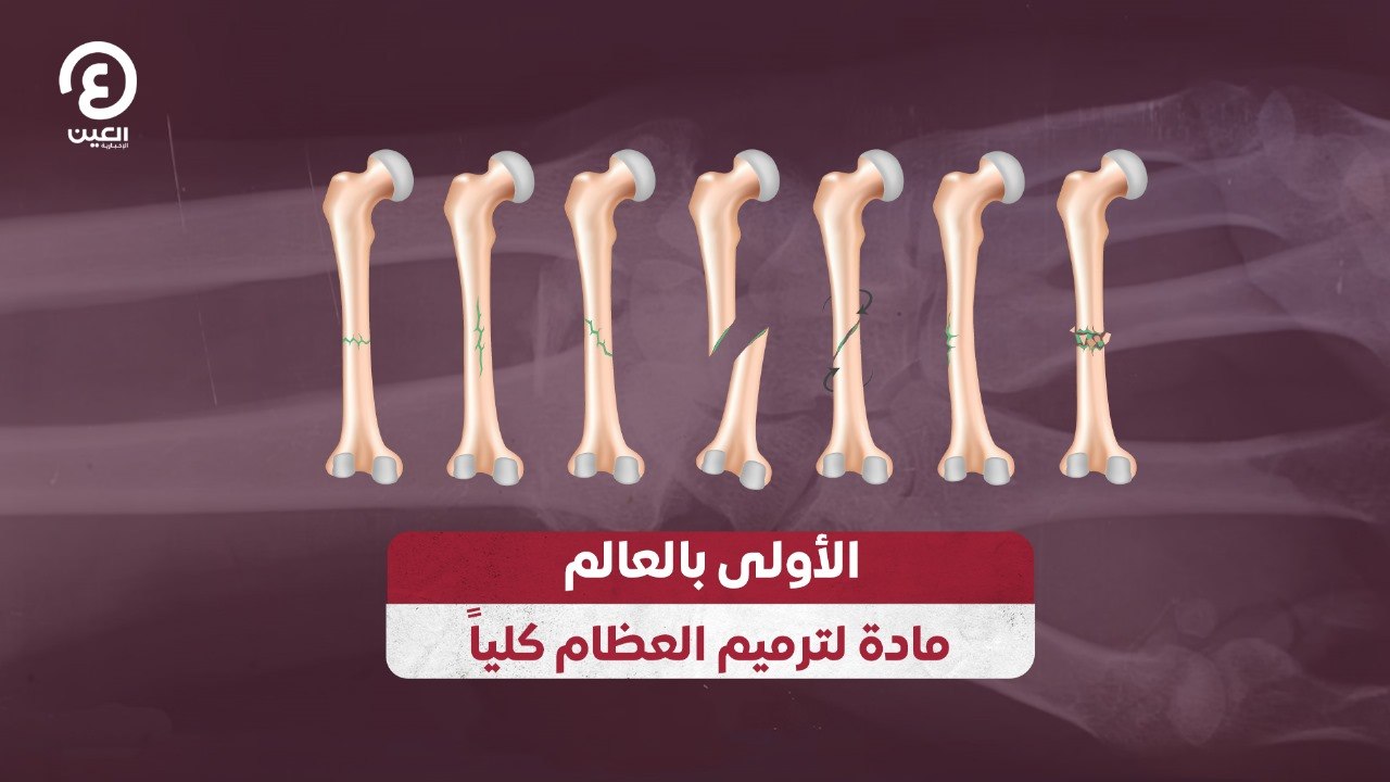 الأولى بالعالم مادة لترميم العظام كلياً