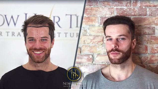 Hair Transplant Before and After | Hair Transplant Results