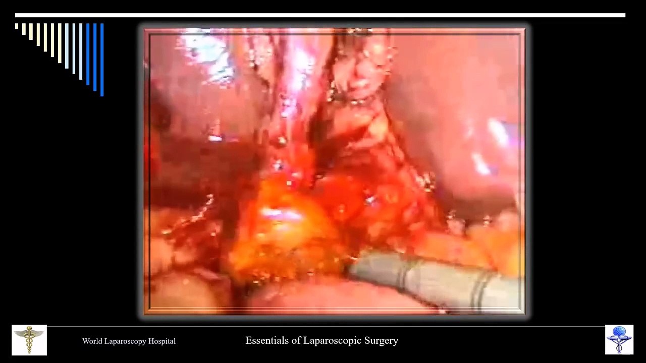 How to do Safe Laparoscopic Choledocotomy - Lecture by Dr R K Mishra