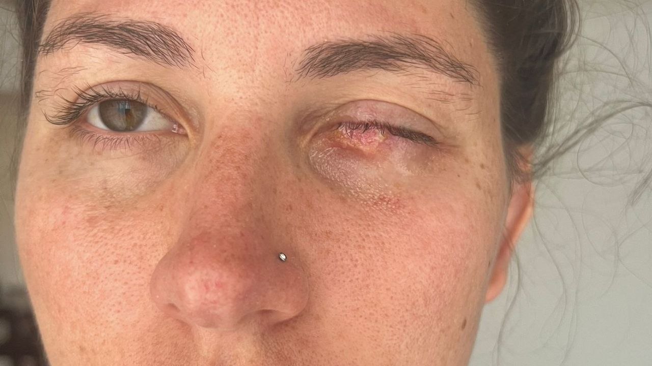 Mum has eye SEWN SHUT to treat skin cancer after lash technician