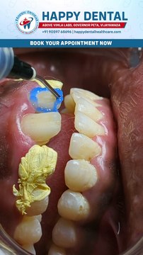 Smile Designing in Vijayawada | Happy Dental India | Dental Veneers