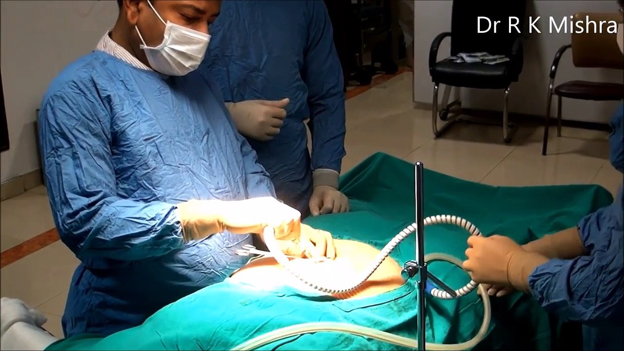 How to do Safe Laparoscopic Fundoplication - Lecture by Dr R K Mishra